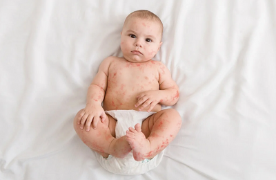 Ronchas en la piel en niños; ¿A qué se deben? ¡Aprende a identificarlas!